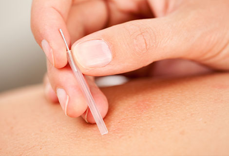 Dry Needling Treatment for auto accident injury